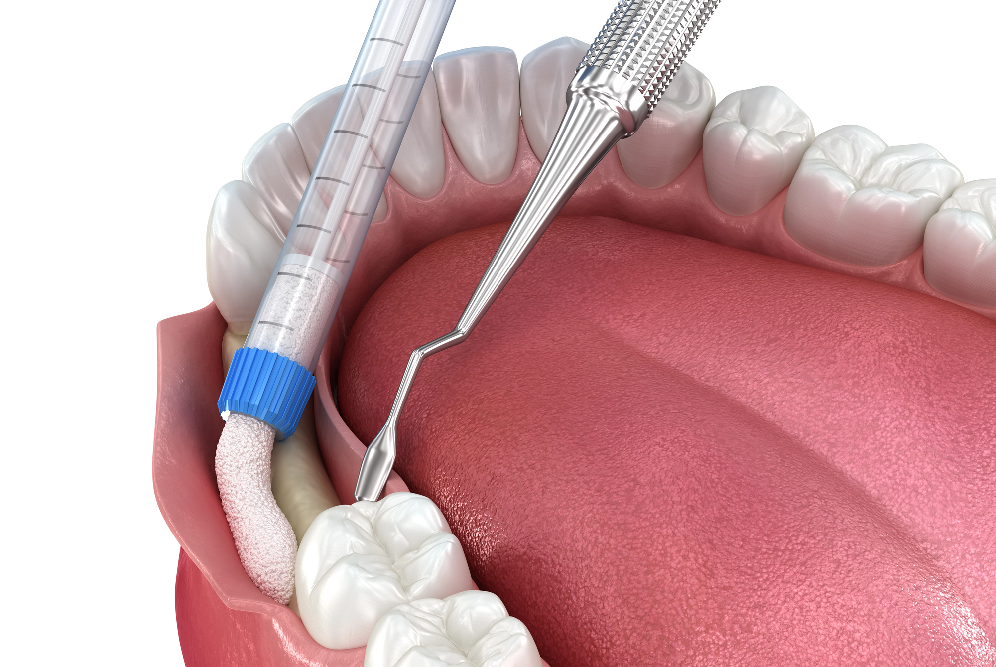 Bone Grafting