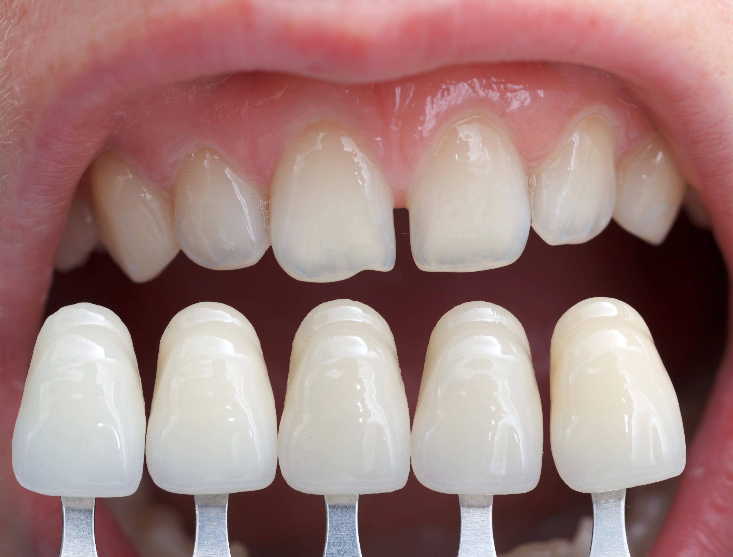 Dental Veneer for Front Teeth: Enhance Your Smile Naturally