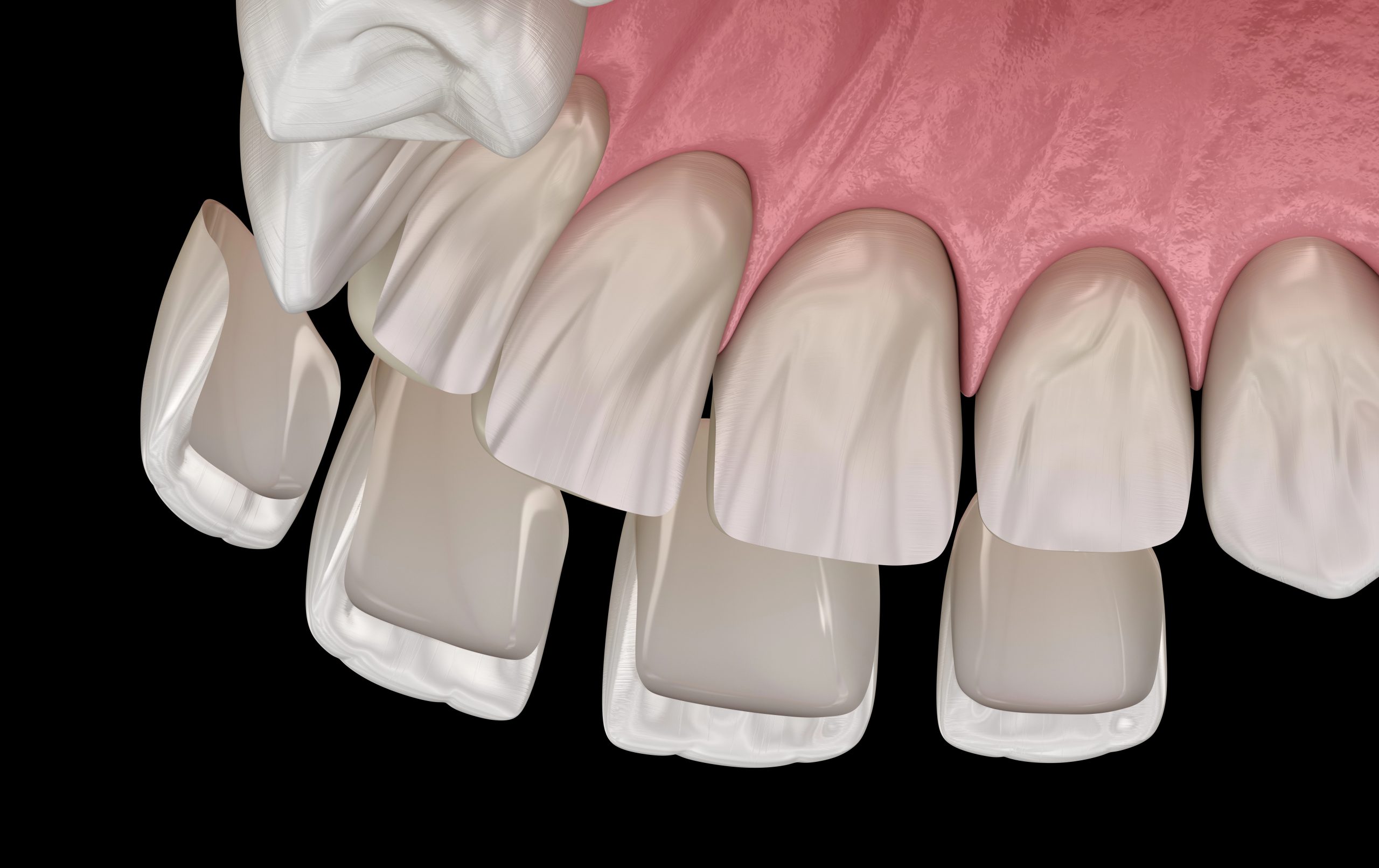 Dental Veneer for Chipped Tooth Repair: A Quick Fix for a Lasting Smile