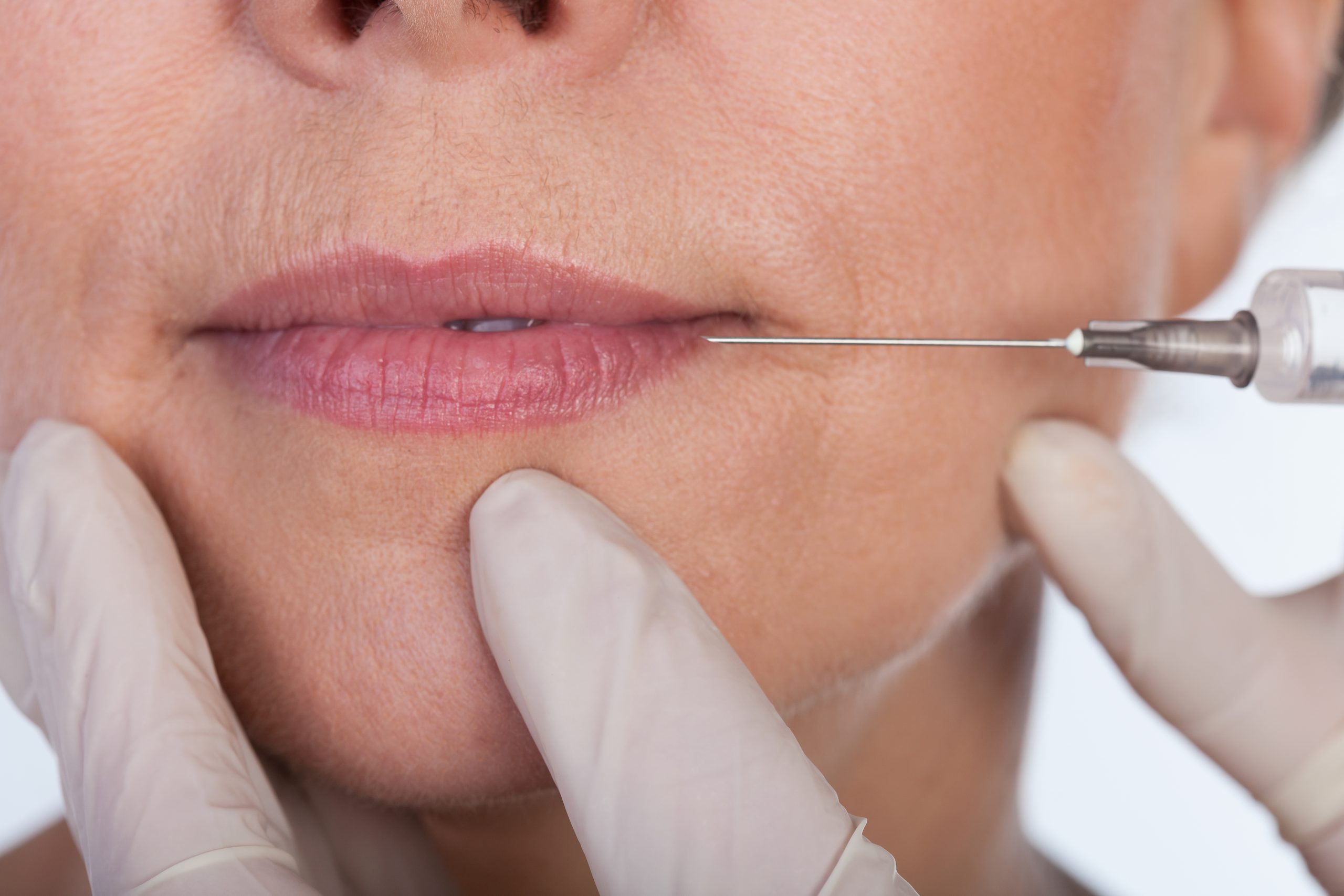 How Botox Can Perfectly Balance and Enhance a Gummy Smile