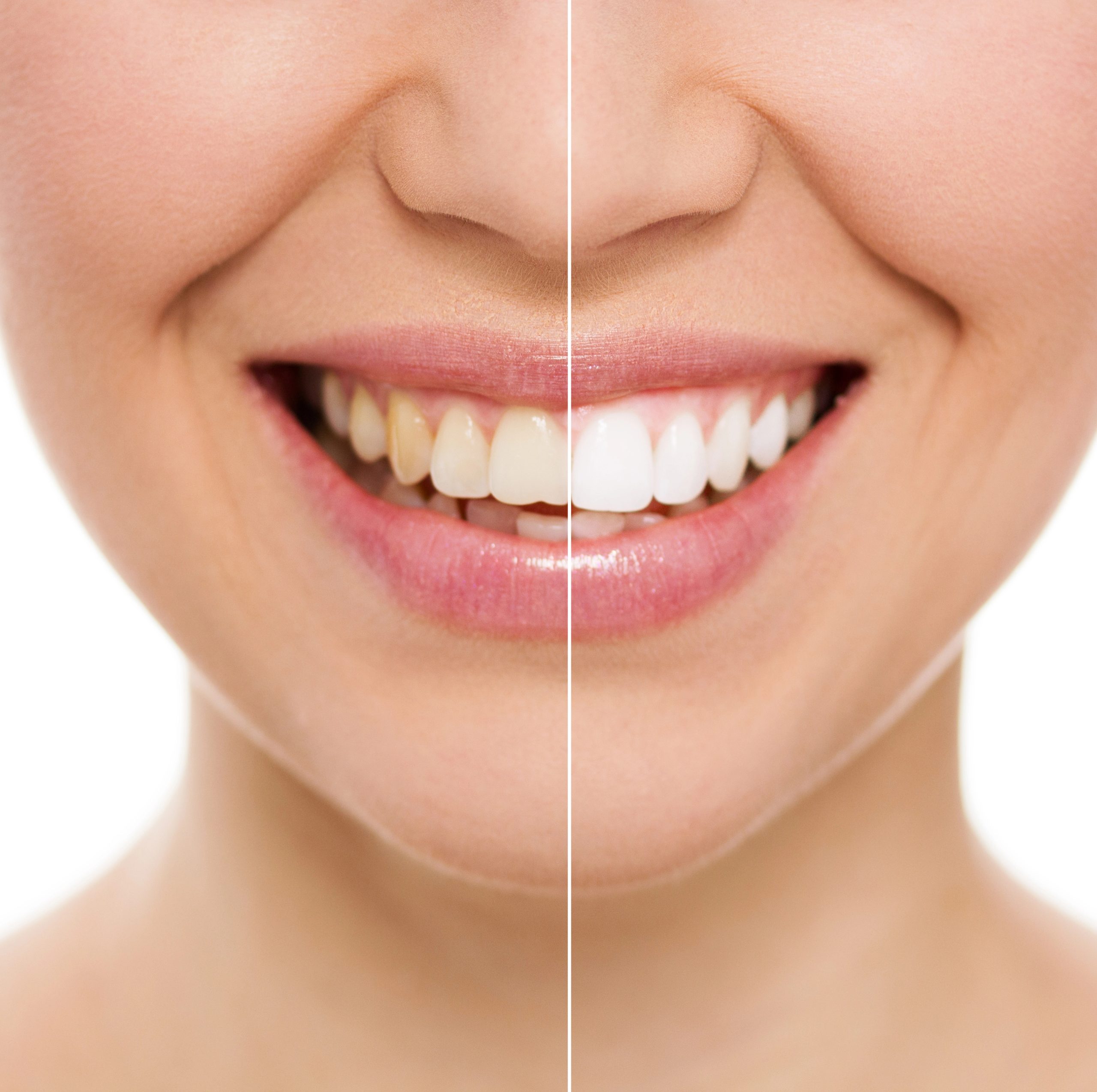 Discover How Oral Hygiene Plays a Crucial Role in Effective Teeth Whitening