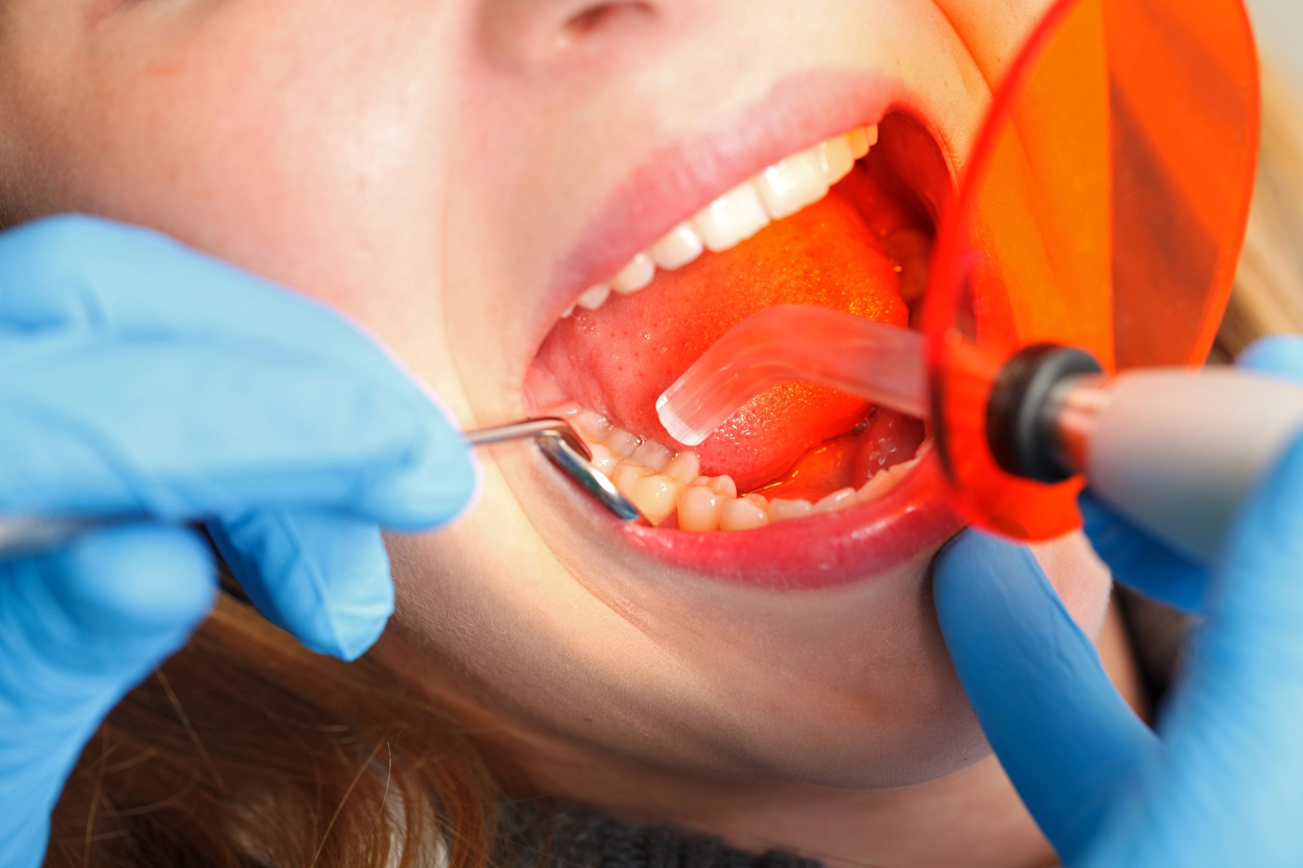 Exploring the Lifespan of Various Tooth Fillings Materials for Better Dental Health